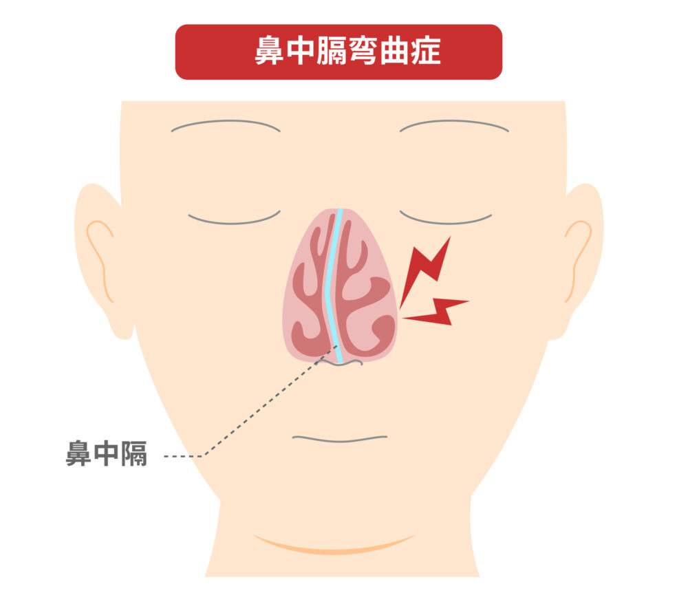 鼻中隔弯曲症とは？