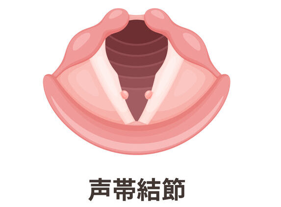 声帯結節