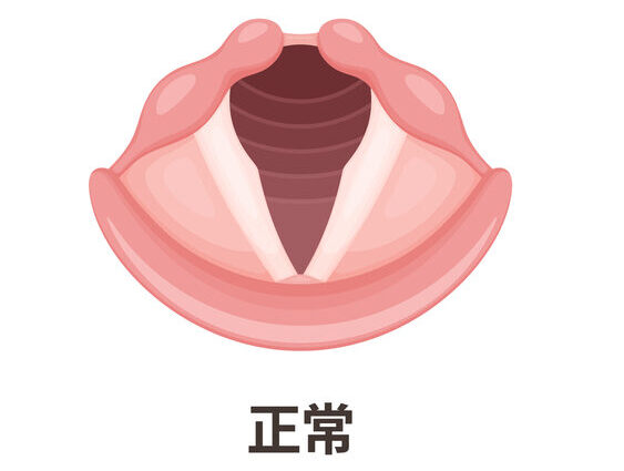 声帯ポリープ・声帯結節・ポリープ様声帯