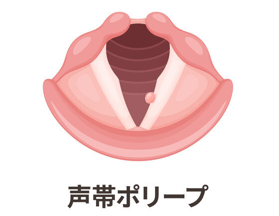 声帯ポリープ